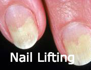 nail-lifting-problem-image