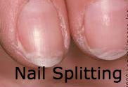 common-nail-problems-nail-splitting-image